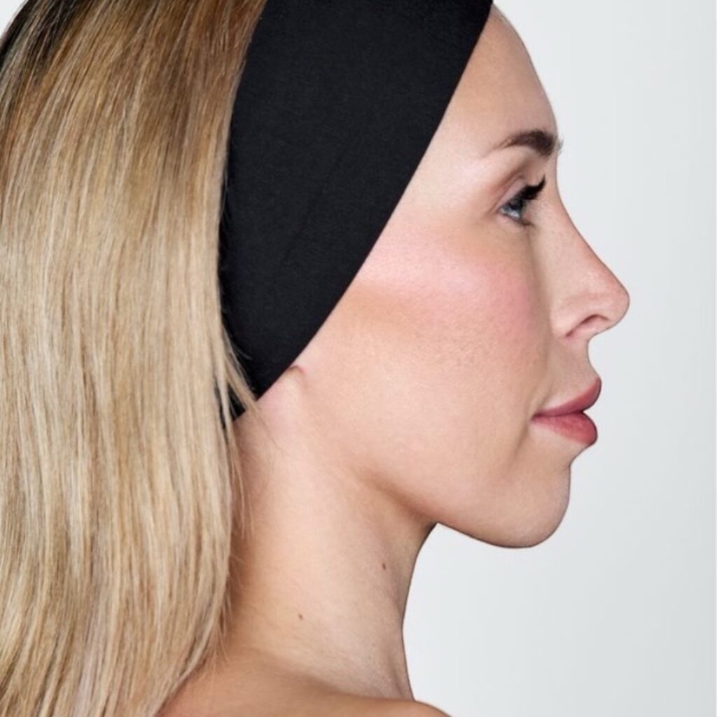 Professionelle Jawline und Profilharmonisierung bei Natural Aesthetic Berlin