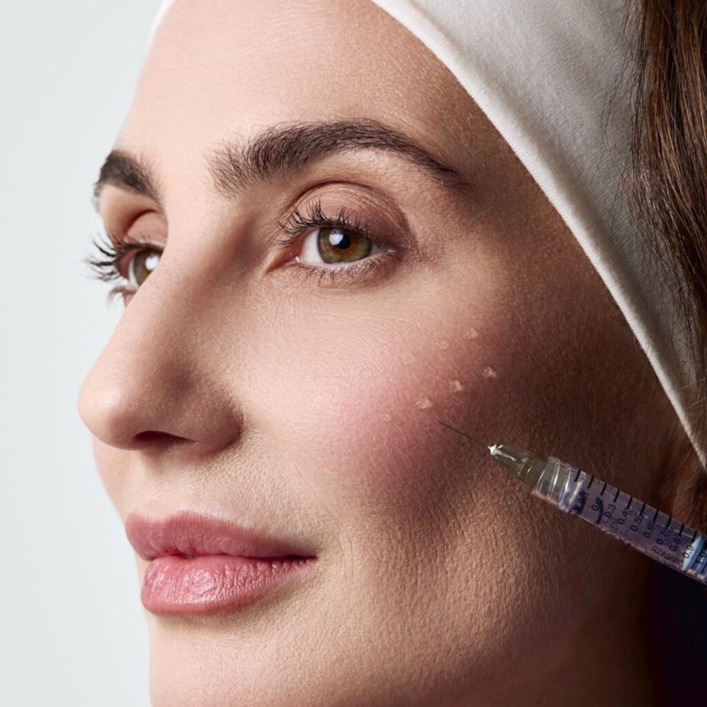 Hyaluron Behandlung gegen Nasolabialfalten bei Natural Aesthetic Berlin